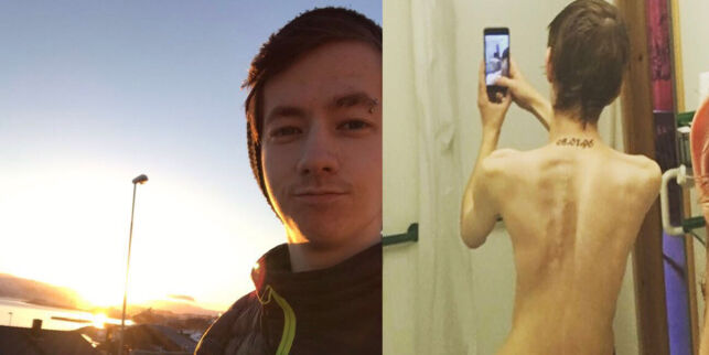 Thor-Egil (21) har en jernstang i ryggen. Om fem til ni år knekker den: - Da kommer jeg til å dø