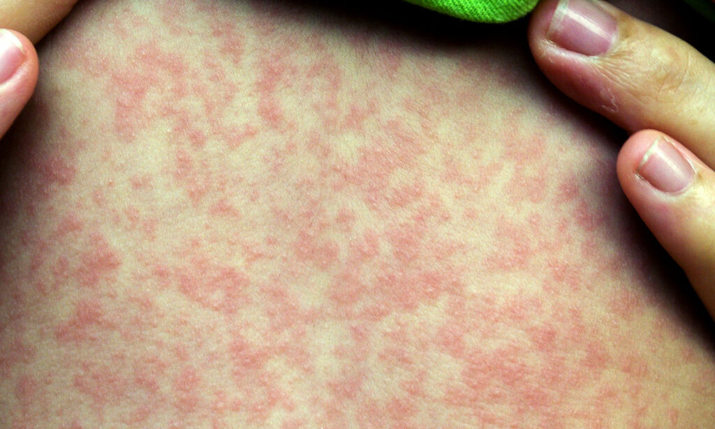 Tre nordmenn er smittet av meslinger: - Smitter lett